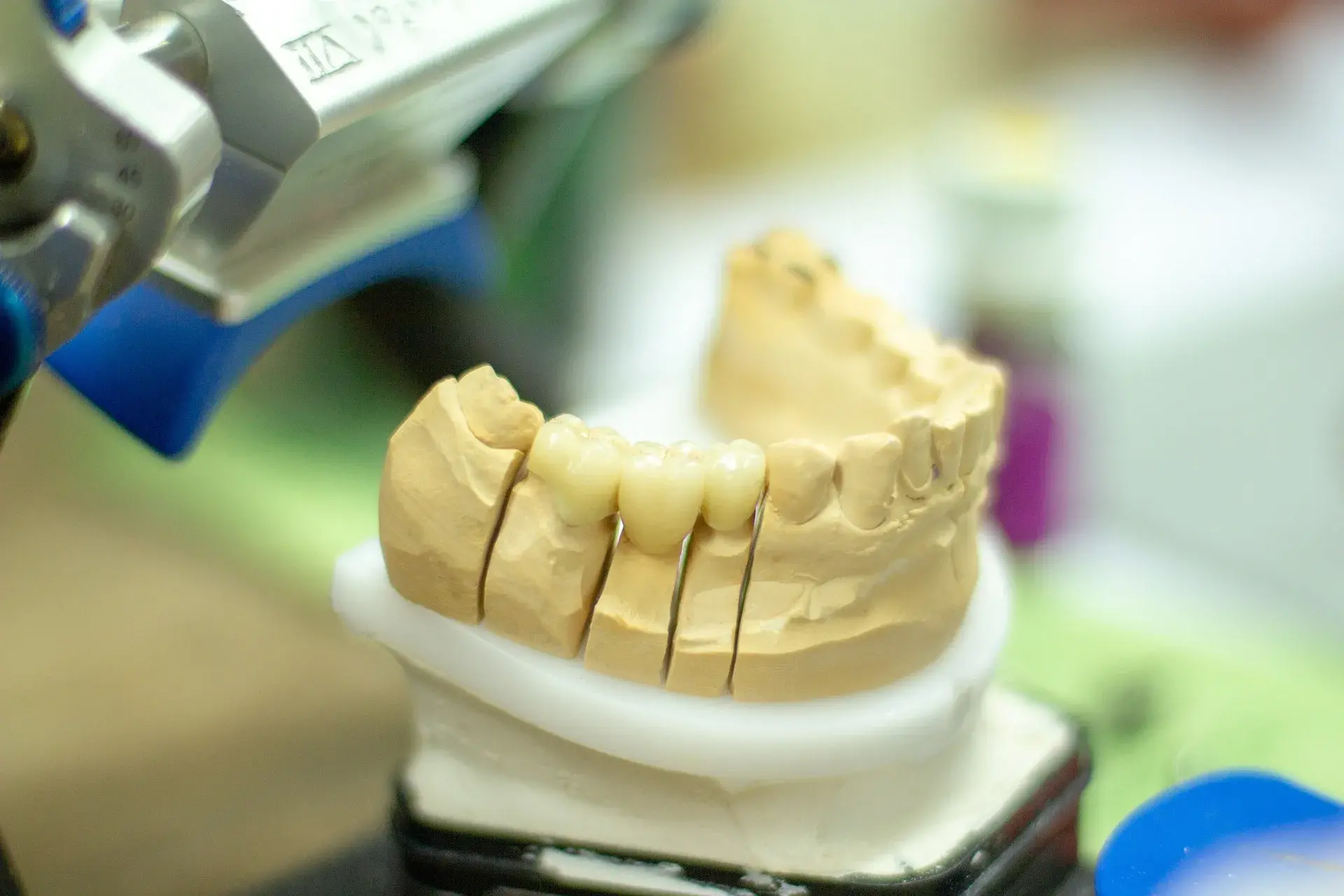 Konsultasi Gigi: Penggunaan Gigi Palsu